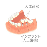 implant_hikaku1