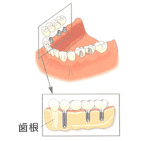 implant_hikaku2