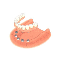implant_hikaku3